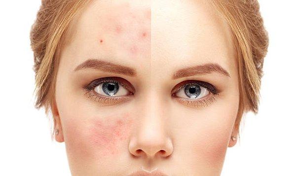 Acne Scar Treatment