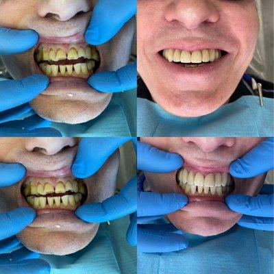 8 Veneers