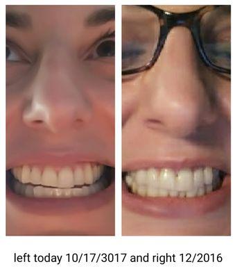 Before and after -- after braces on left  And the right side is December 2016.