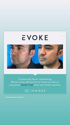 Inmode EVOKE RF (no needles, no downtime) 6 sessions recommended