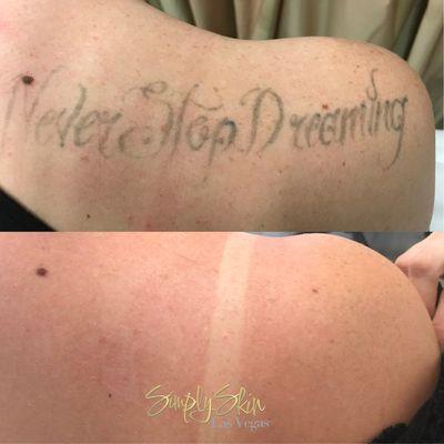 Tattoo Removal Before and After