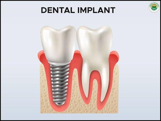 Dental Implant explained