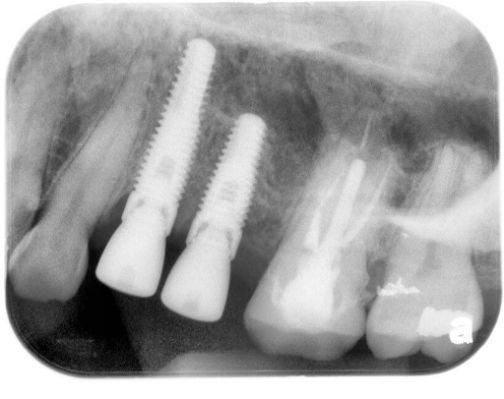 Example of what Implants look like on X-rays