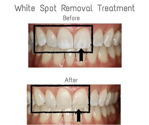 White Spot Removal Treatment