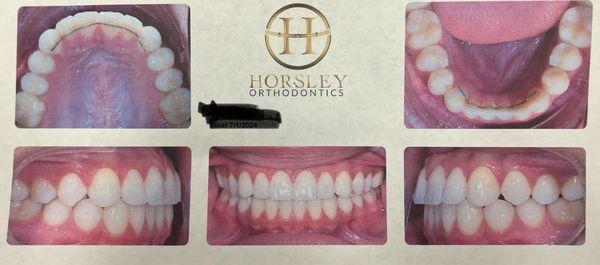 Just finished our last visit with Horsley Orthodontics! Final results are AMAZING! We are thrilled with the outcome!!