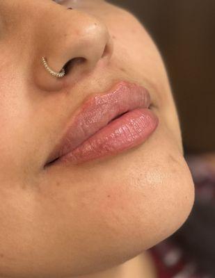 Lip Filler