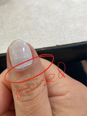 Bruised cuticle