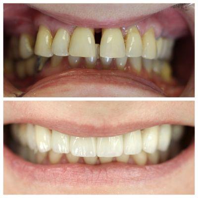 Full mouth implants and esthetic all zirconia.porcelain crowns