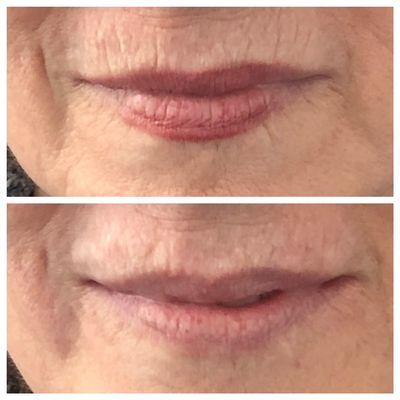 Juvederm for perioral or vertical lines around mouth.