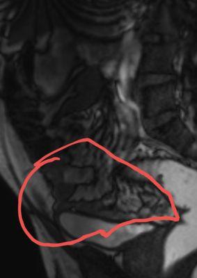 Enterocele, and volvulus wrapping around sigmoid colon. Pile of small intestine wrapped around sigmoid colon literally