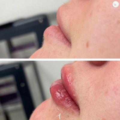 Ready to plump that pout? We love what a small amount of filler can do!