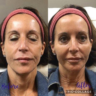 Liquid face lift