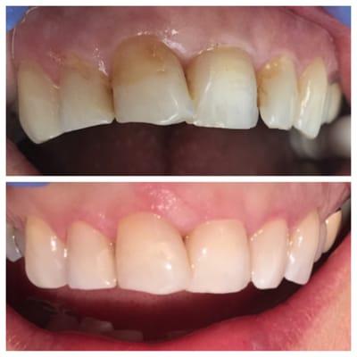 A simple and inexpensive alternative to porcelain veneers...composite bonding.