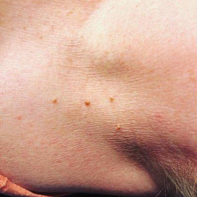 Skin tag removal