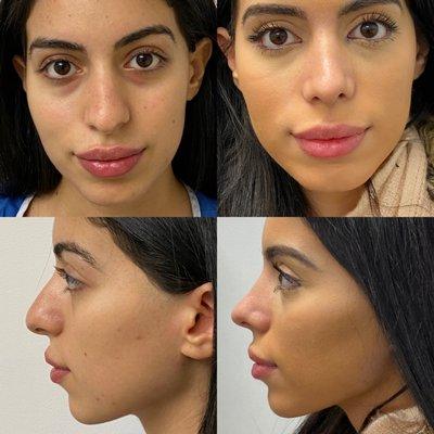 This is three weeks post op of a Before and after of the rhinoplasty procedure