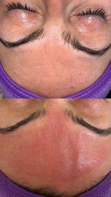 The before and after results of ONE micro needling session (immediately after treatment)