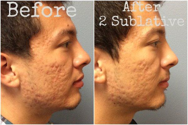 We offer Sublative laser to help with acne scars.