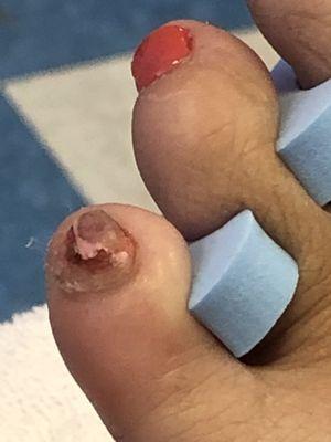 This is what my toe looked like. He tried painting over the damaged area but it was burning so I told him to take it off.