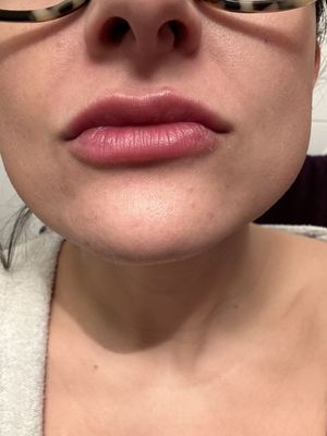 a few days after a light filler treatment