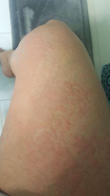 Hives all over my body due to Dr. Josephine Osire gaving me a medication that had an adverse reaction to medications I'm currently taking.