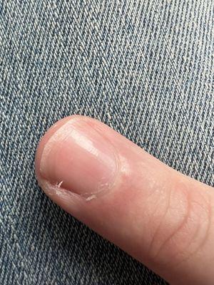 Cuticles left ripped up