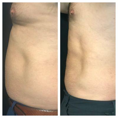 Lose the extra fat while tightening & sculpting your body- schedule an appointment and see what's possible!