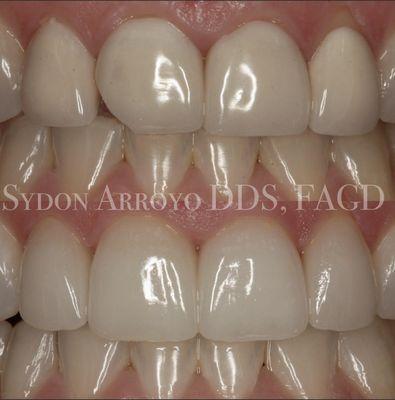 Porcelain Veneers