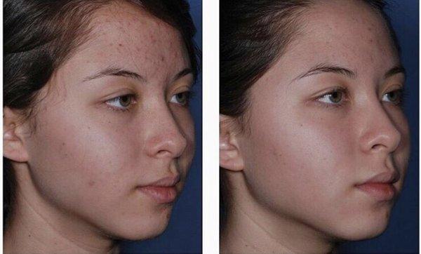 Acne treatment using Clenziderm