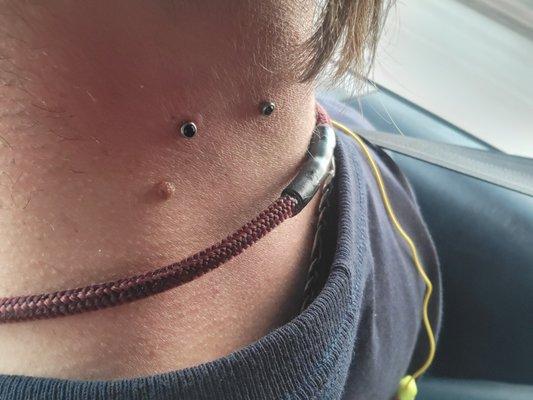 This pic is from a couple weeks after I got my dermals. They healed up very well!