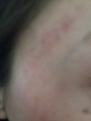 Bruising on forehead from microderm..awful