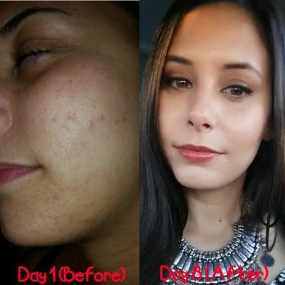 Before and after my medical peel- this is only in 8 days!! Wow, so worth it!