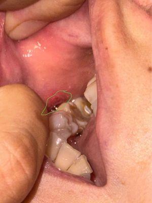 The injured/cut area of inside cheek during the root canal treatment.