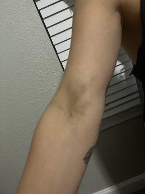 Bruising at the donation site.