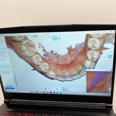 Digital intraoral scanner