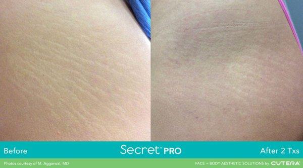 Secret RF - Before & After (Stretch Marks)