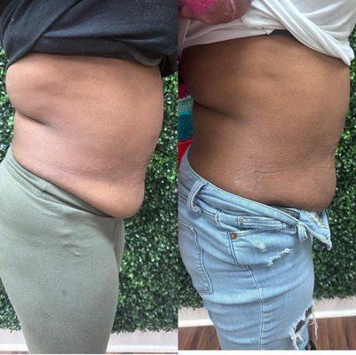 Try a non-surgical liposuction with Lipo Dissolve to target stubborn fat area. If you are  hesitant about traditional lipo, this is for you!