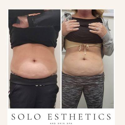 Cryo Body Contouring,  4 treatments, 2 week apart