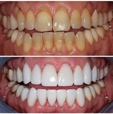 Teeth Whitening: Before & After