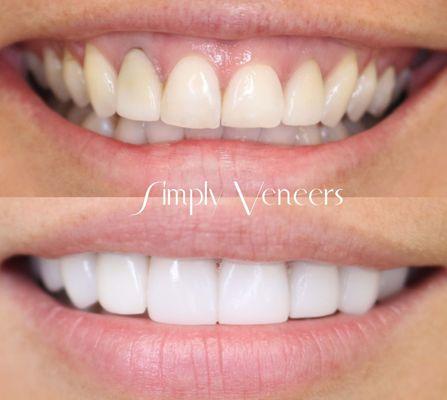 Smile makeover using porcelain laminates for a fuller dazzling smile