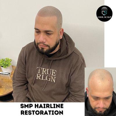 Complete Hairline restoration