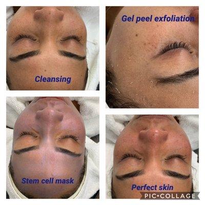 Glass look skin texture after gommage gel peel facial.