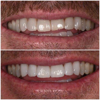 Updated cosmetic ceramic emax veneers with much more character and personality