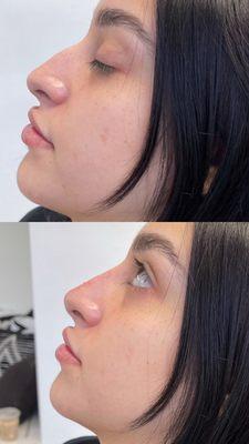 Non surgical nose job