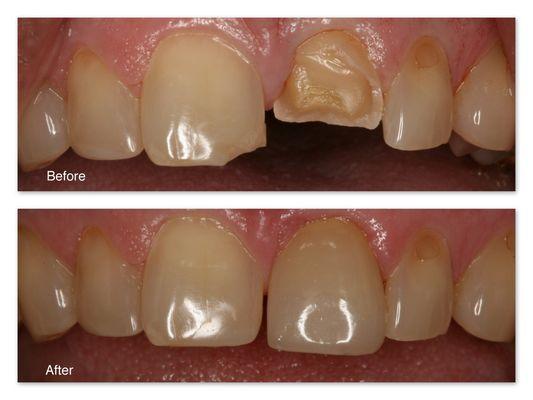 before and after photos of a chipped tooth and new bonded tooth.