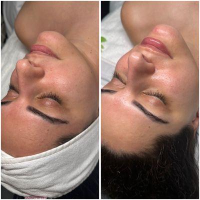 Lets Glow Girl Facial - Our dermaplaning facial by Andreia