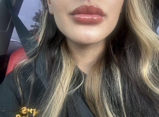 Restylane Kysse Lip Filler