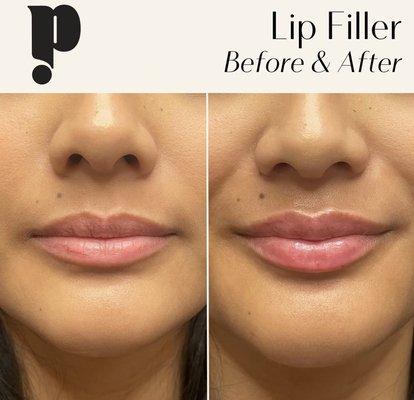 Lip Filler by Felisha