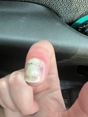 Infected index fingernail.