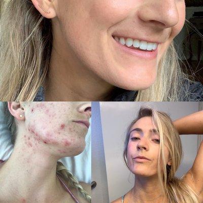 Acne: Before + After