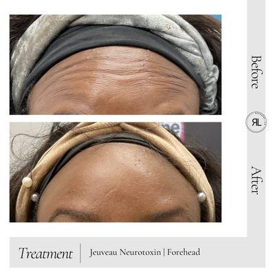 Forehead Botox | Jeuveau | Med Spa